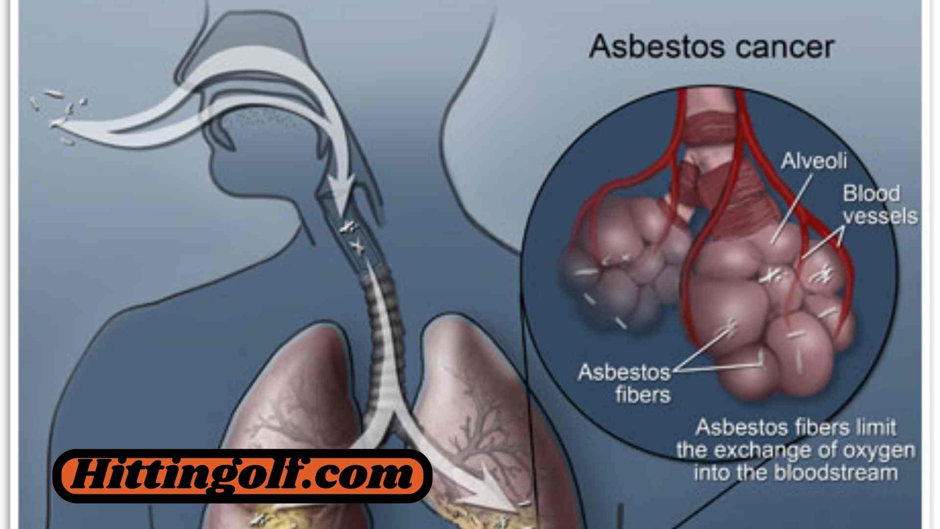 Giving Monetary Help to Mesothelioma Casualties: A Pivotal LifeSaver in the Battle Against Asbestos-Related Sicknesses